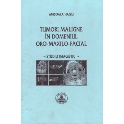 Tumori maligne in domeniul oro-maxilo-facial - Anisoara Hagiu